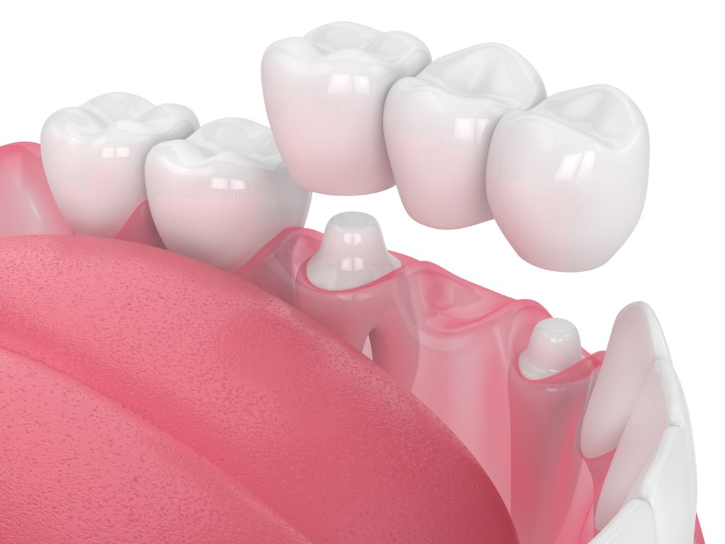Illustration of a dental bridge being placed into a bottom row of teeth