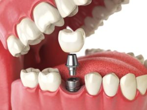 Illustration of an open mouth with a dental implant being installed in the bottom row