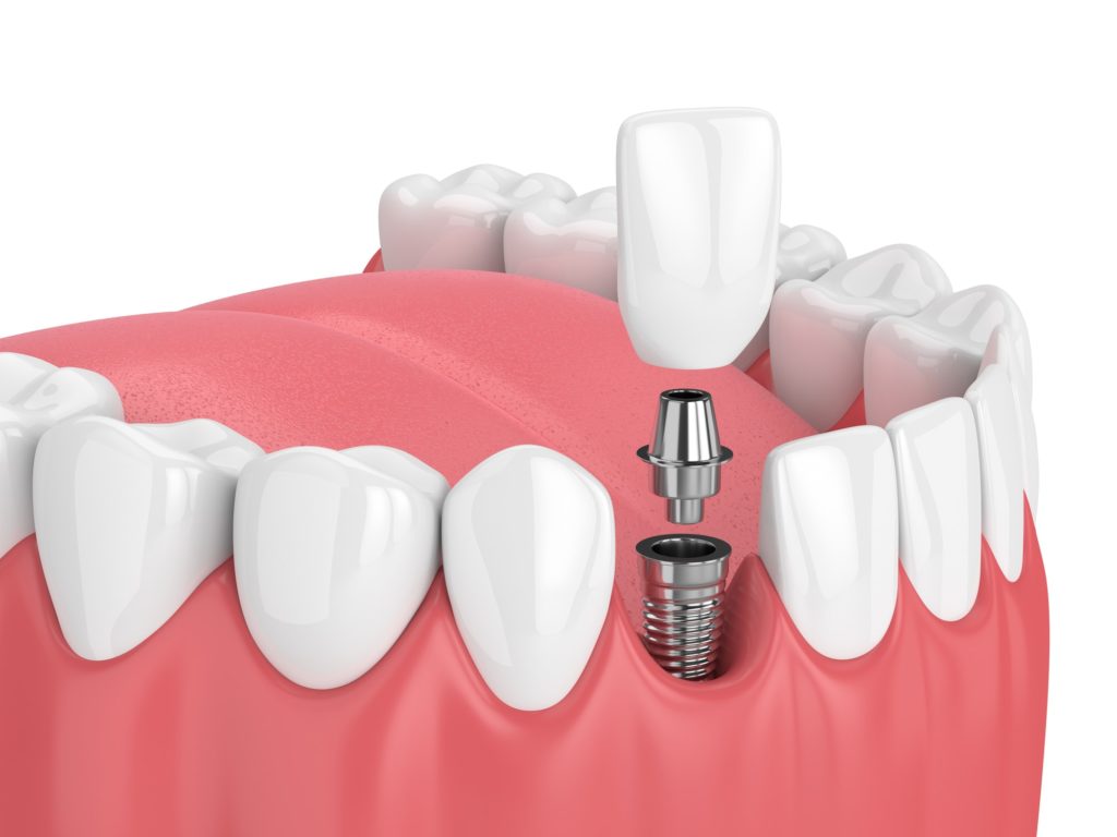 Illustration showing a bottom row of teeth with a dental implant being installed