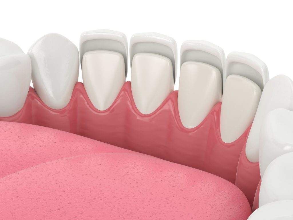 Illustration of dental veneers being placed onto a bottom row of teeth