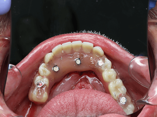 post op smile gallery for dental implants in la vista, ne