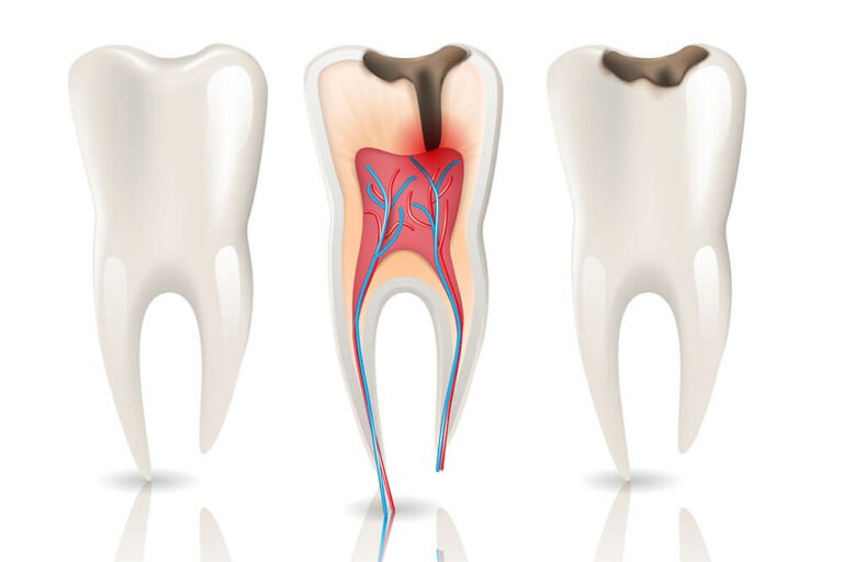 three teeth showing various stages of tooth decay